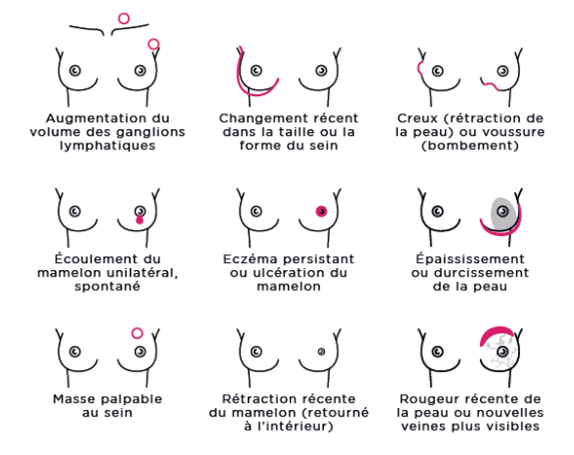 Cancer_du_sein_signes_et_symptomes